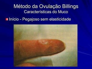 Método da Ovulação Billings
Características do Muco
Início - Pegajoso sem elasticidade
 