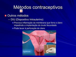 Métodos contraceptivos
Outros métodos
– DIU (Dispositivo Intrauterino)
Provoca inflamação da membrana que forra o útero
impedindo a implantação do óvulo fecundado
Pode levar à perfuração do útero
 