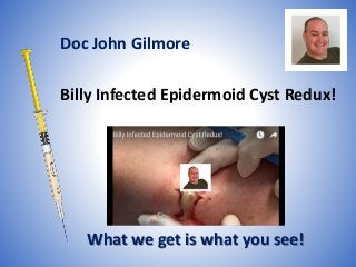 Billy Infected Epidermoid Cyst Redux!
What we get is what you see!
Doc John Gilmore
 