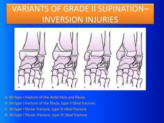 Bimalleolar fracture.pptx
