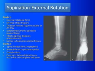 Bimalleolar fracture.pptx