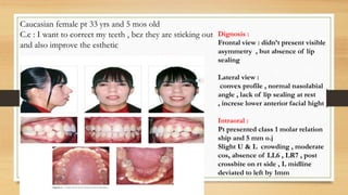 Dignosis :
Frontal view : didn’t present visible
asymmetry , but absence of lip
sealing
Lateral view :
convex profile , normal nasolabial
angle , lack of lip sealing at rest
, increse lower anterior facial hight
Intraoral :
Pt presented class 1 molar relation
ship and 5 mm o.j
Slight U & L crowding , moderate
cos, absence of LL6 , LR7 , post
crossbite on rt side , L midline
deviated to left by 1mm
Caucasian female pt 33 yrs and 5 mos old
C.c : I want to correct my teeth , bcz they are sticking out
and also improve the esthetic
 