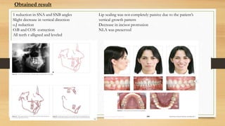 1 reduction in SNA and SNB angles
Slight decrease in vertical direction
o.J reduction
O.B and COS correction
All teeth r alligned and leveled
Lip sealing was not completely passive due to the patient’s
vertical growth pattern
Decrease in incisor protrusion
NLA was preserved
Obtained result
 