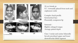 24 yrs female pt
CC : forwardly placed front teeth and
unpleasent smile
Complex facial profile
Symmetrical face
Potentially competent lip
Intraoral :
Slightly enlarged tongue
Average palatal depth
Class 1 molar and canine bilaterally
Severly proclined upper and lower
dentoalveolar labial segment
 