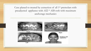 Case planed to treated by extraction of all 1st premolars with
preadjusted appliance with .022 * .028 roth with maximum
anchorage mechanics
 