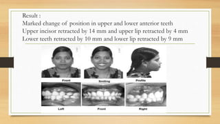 Result :
Marked change of position in upper and lower anterior teeth
Upper incisor retracted by 14 mm and upper lip retracted by 4 mm
Lower teeth retracted by 10 mm and lower lip retracted by 9 mm
 