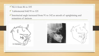 NLA from 86 to 105
 Labiomental fold 91 to 121
Interincisal angle increased from 91 to 142 as aresult of uprightining and
retraction of incisors
 