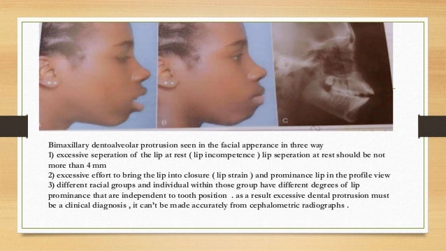 bimaxillary protrusion forward maxilla proclination swinging cause could teeth fix correction lips
