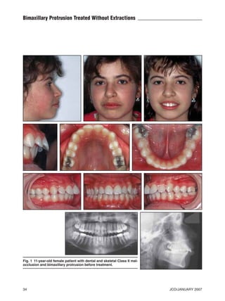 P.33-38 Celli:CR_Celli   1/10/07   2:49 PM   Page 34




           Bimaxillary Protrusion Treated Without Extractions




           Fig. 1 11-year-old female patient with dental and skeletal Class II mal-
           occlusion and bimaxillary protrusion before treatment.




           34                                                                         JCO/JANUARY 2007
 