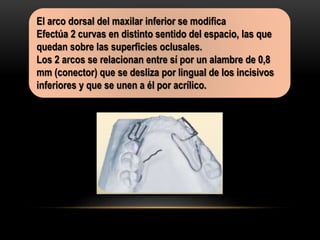 El arco dorsal del maxilar inferior se modifica
Efectúa 2 curvas en distinto sentido del espacio, las que
quedan sobre las superficies oclusales.
Los 2 arcos se relacionan entre sí por un alambre de 0,8
mm (conector) que se desliza por lingual de los incisivos
inferiores y que se unen a él por acrílico.
 
