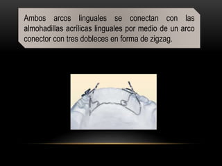 Ambos arcos linguales se conectan con las
almohadillas acrílicas linguales por medio de un arco
conector con tres dobleces en forma de zigzag.
 