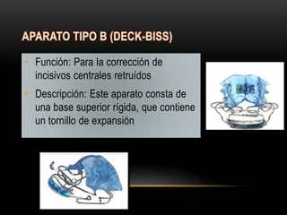 • Función: Para la corrección de
incisivos centrales retruídos
• Descripción: Este aparato consta de
una base superior rígida, que contiene
un tornillo de expansión
 