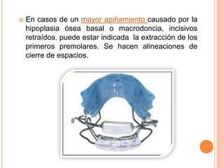 

En casos de un mayor apiñamiento causado por la
hipoplasia ósea basal o macrodoncia, incisivos
retraídos. puede estar indicada la extracción de los
primeros premolares. Se hacen alineaciones de
cierre de espacios.

 