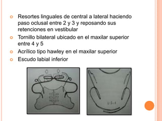 






Resortes linguales de central a lateral haciendo
paso oclusal entre 2 y 3 y reposando sus
retenciones en vestibular
Tornillo bilateral ubicado en el maxilar superior
entre 4 y 5
Acrílico tipo hawley en el maxilar superior
Escudo labial inferior

 