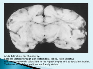 Acute bilirubin encephalopathy.
Coronal section through parietotemporal lobes. Note selective
symmetric yellow discoloration in the hippocampus and subthalamic nuclei.
Thalamus and globus pallidus are focally stained.
 