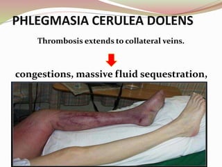 PHLEGMASIA CERULEA DOLENS
Thrombosis extends to collateral veins.
congestions, massive fluid sequestration,
edema
 