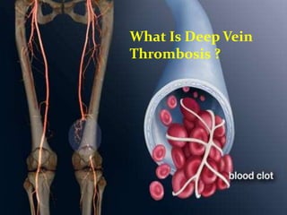 What Is Deep Vein
Thrombosis ?
 