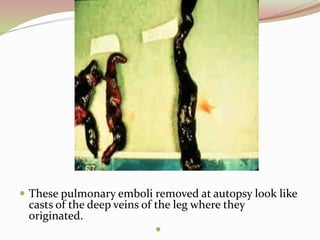  These pulmonary emboli removed at autopsy look like
casts of the deep veins of the leg where they
originated.

 