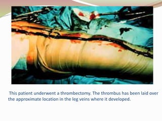 This patient underwent a thrombectomy. The thrombus has been laid over
the approximate location in the leg veins where it developed.
 