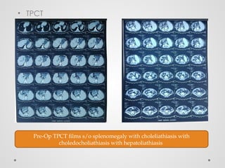 ppt for case of ehpvo and hepatic encephalopathy.pptx