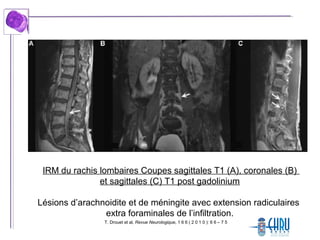 T. Drouet et al, Revue Neurologique, 1 6 6 ( 2 0 1 0 ): 6 6 – 7 5
IRM du rachis lombaires Coupes sagittales T1 (A), coronales (B)
et sagittales (C) T1 post gadolinium
Lésions d’arachnoidite et de méningite avec extension radiculaires
extra foraminales de l’infiltration.
 