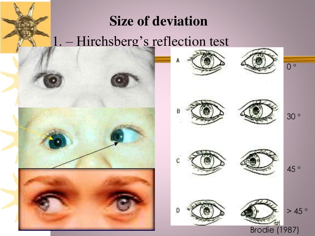 Binocular anomalies What we should know?