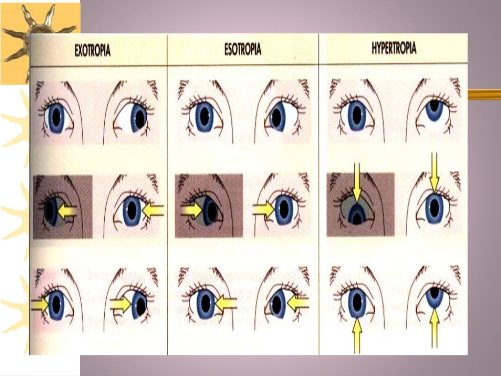 Binocular anomalies What we should know?