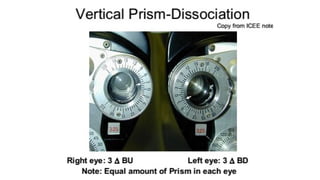 Binocular balance (review) | PPT