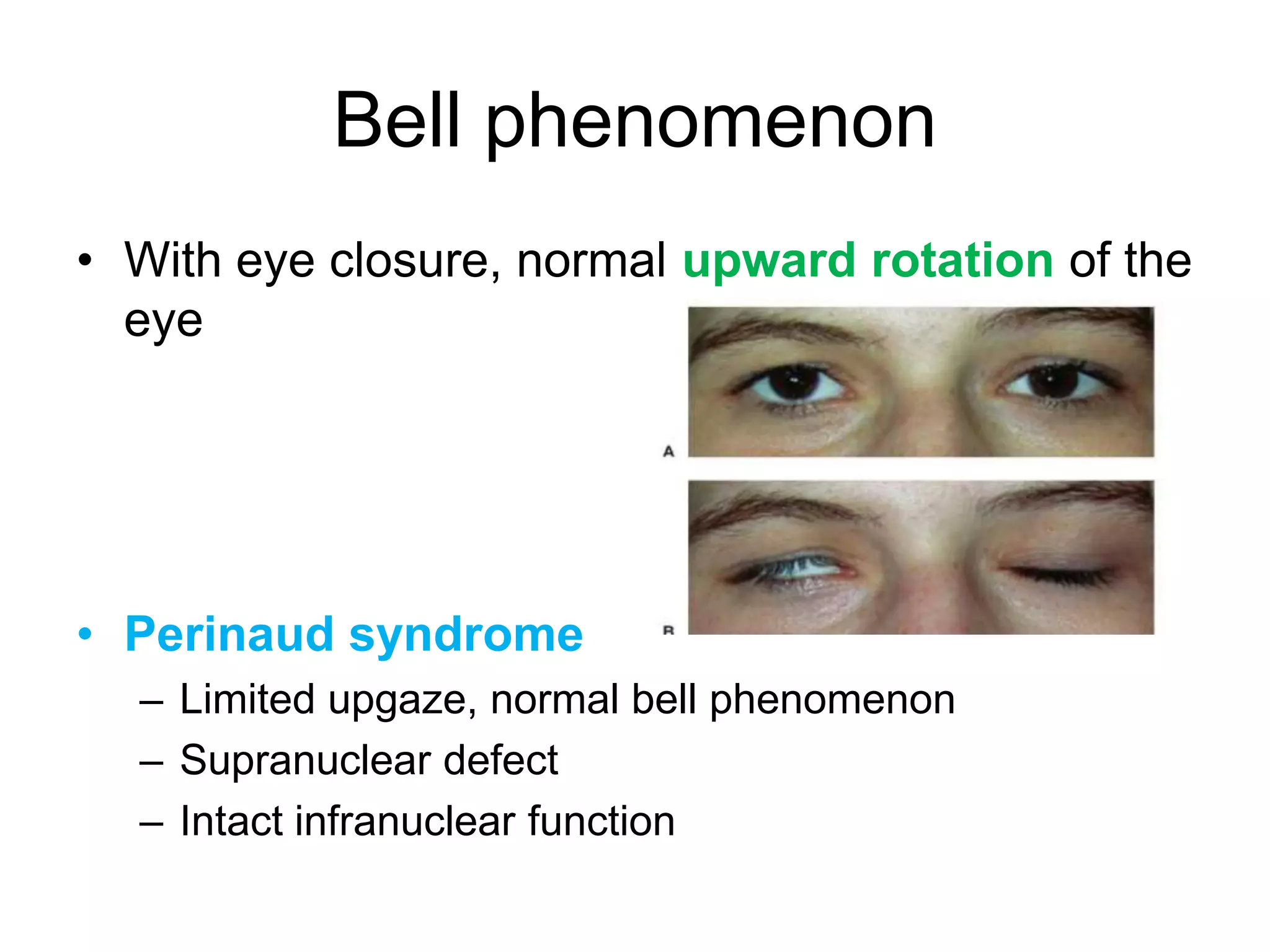 Bell phenomenon
• With eye closure, normal upward rotation of the
  eye




• Perinaud syndrome
  – Limited upgaze, normal bell phenomenon
  – Supranuclear defect
  – Intact infranuclear function
 