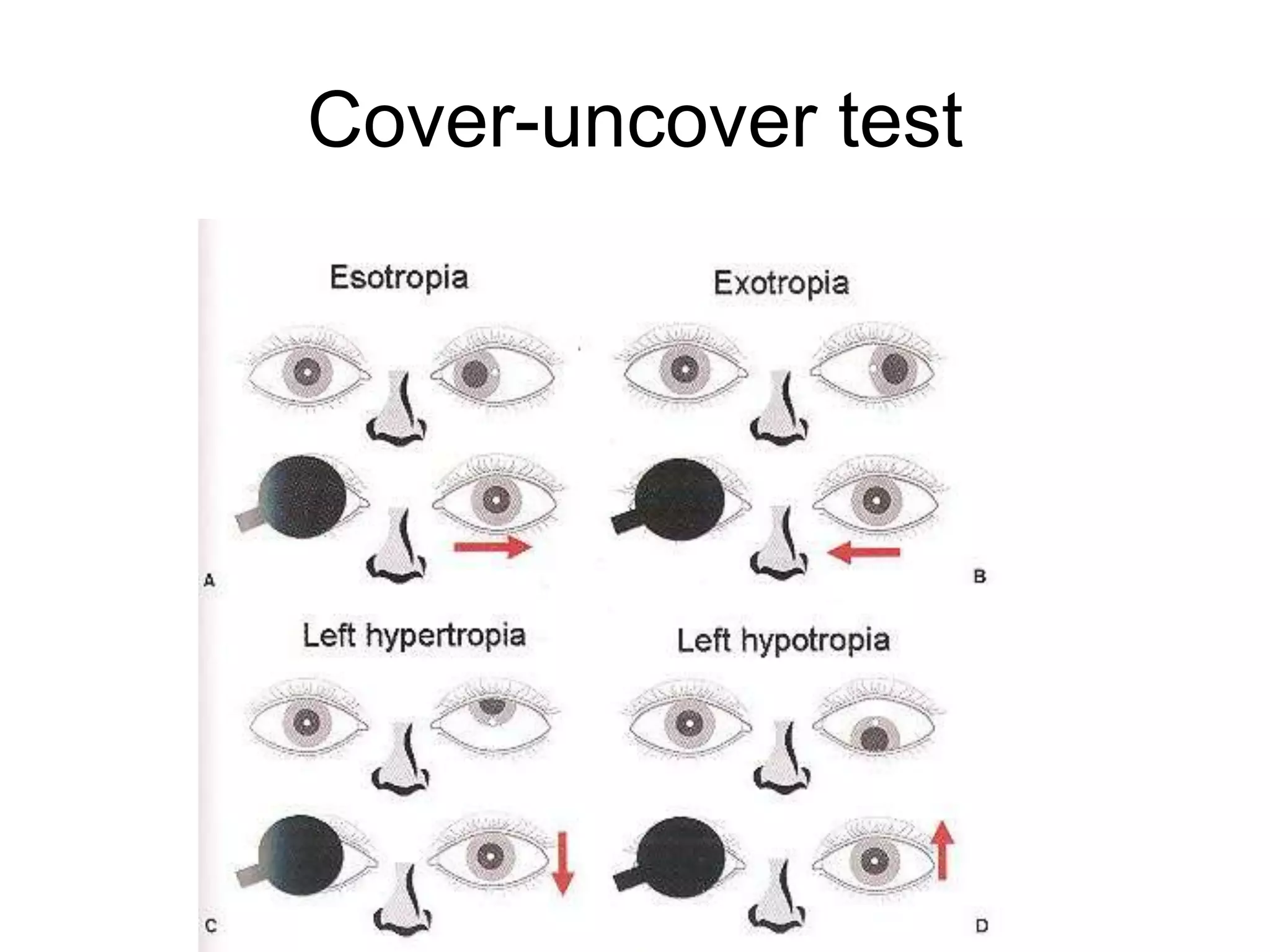 Cover-uncover test
 