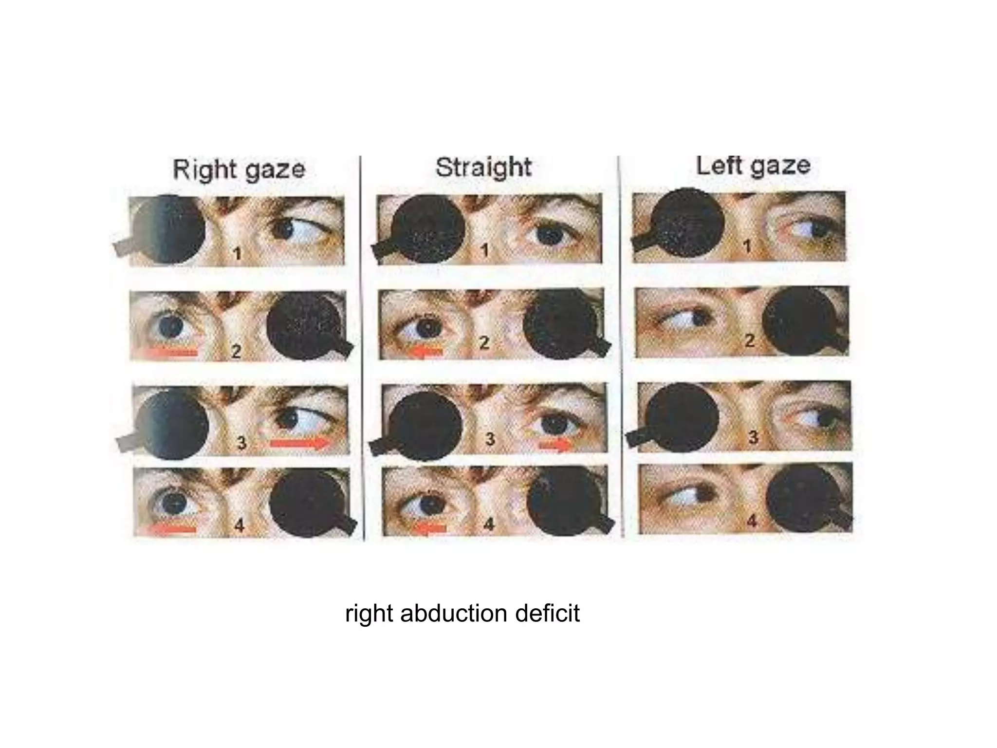 right abduction deficit
 