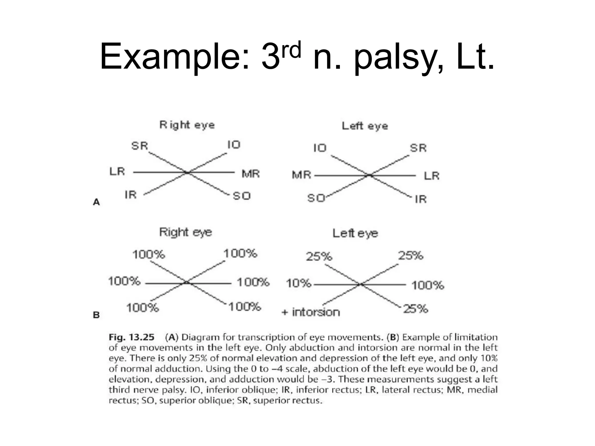Example: 3rd n. palsy, Lt.
 
