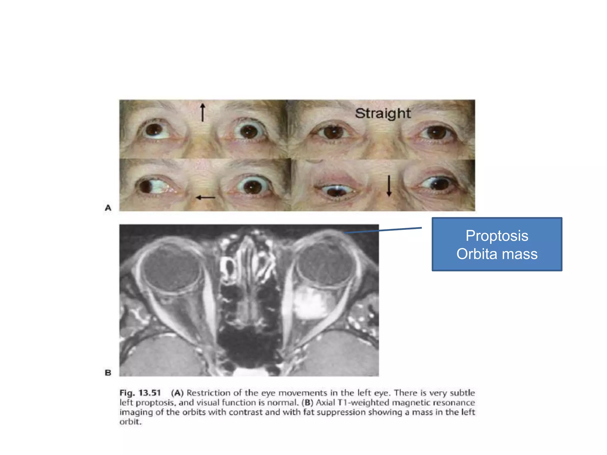 Proptosis
Orbita mass
 
