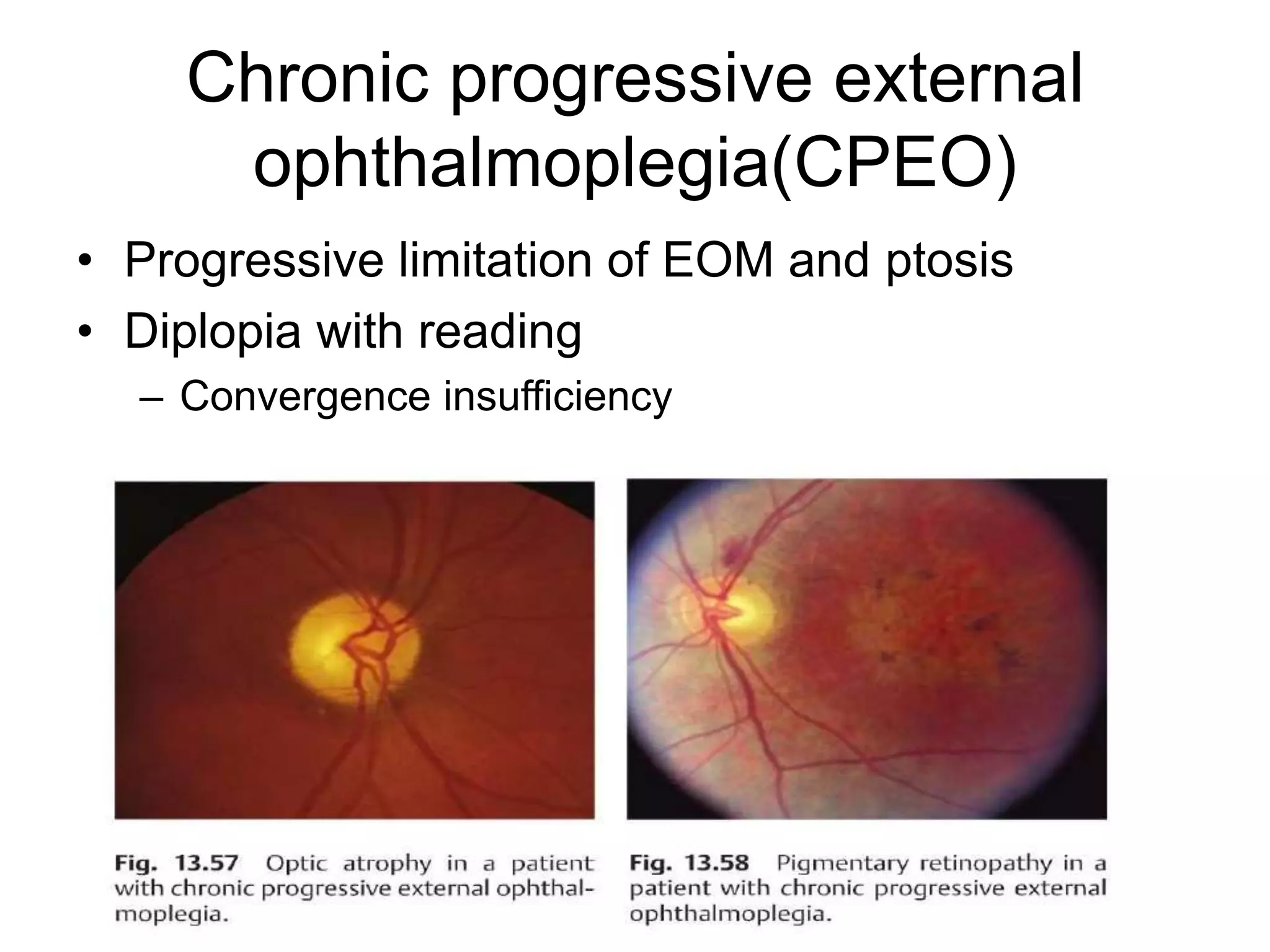 Chronic progressive external
     ophthalmoplegia(CPEO)
• Progressive limitation of EOM and ptosis
• Diplopia with reading
  – Convergence insufficiency
 