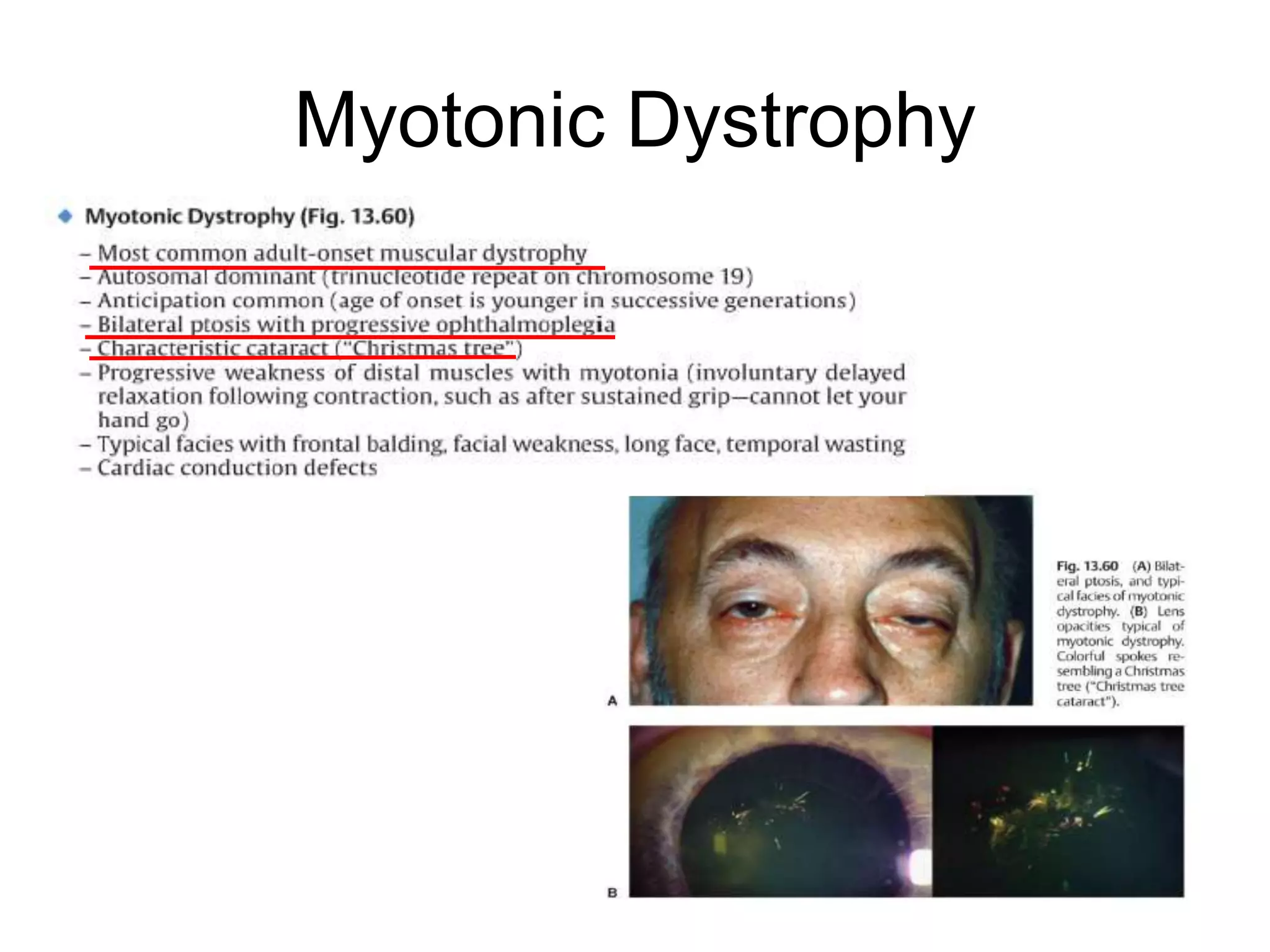 Myotonic Dystrophy
 