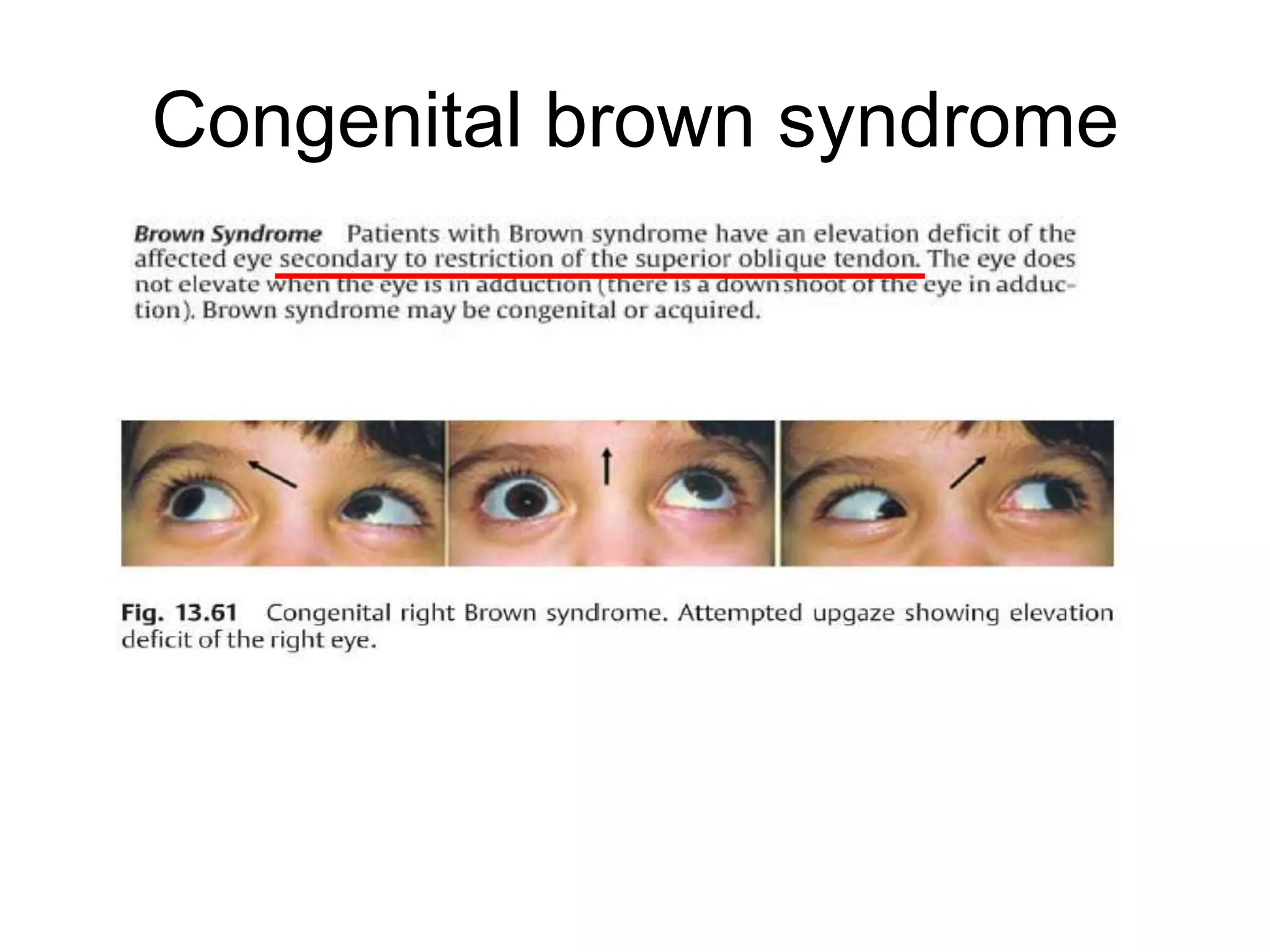Congenital brown syndrome
 