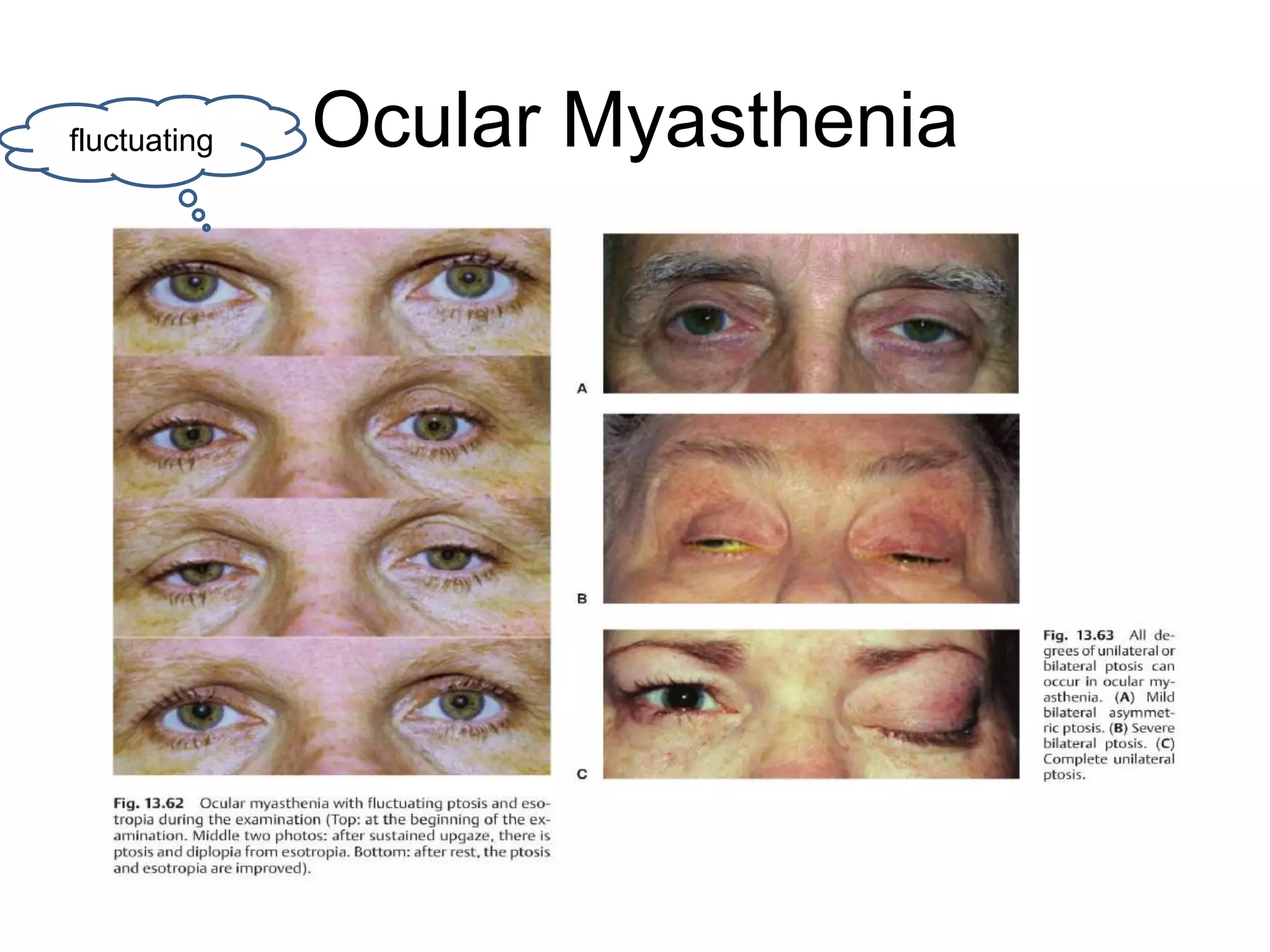 fluctuating   Ocular Myasthenia
 