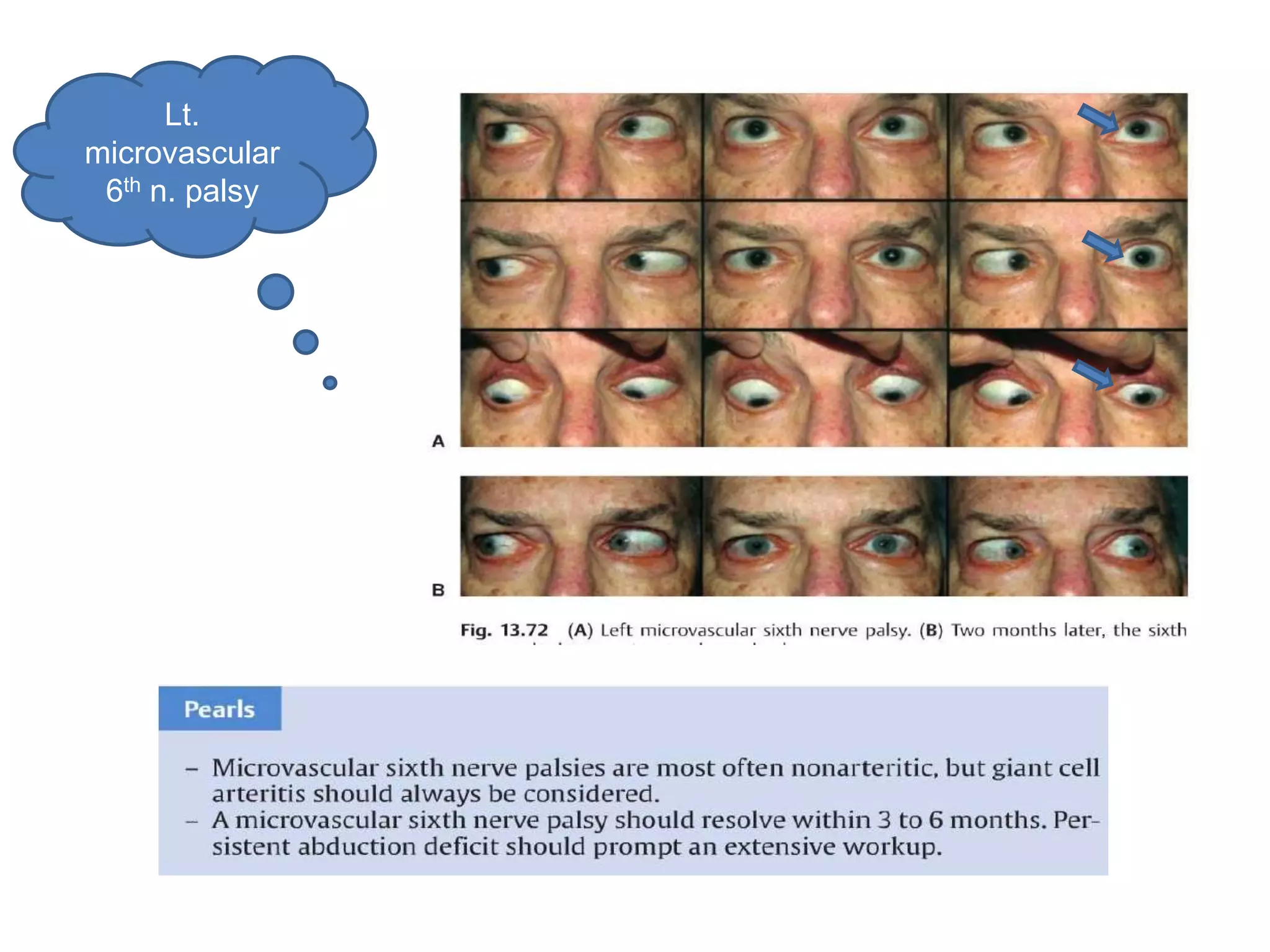 Lt.
microvascular
 6th n. palsy
 