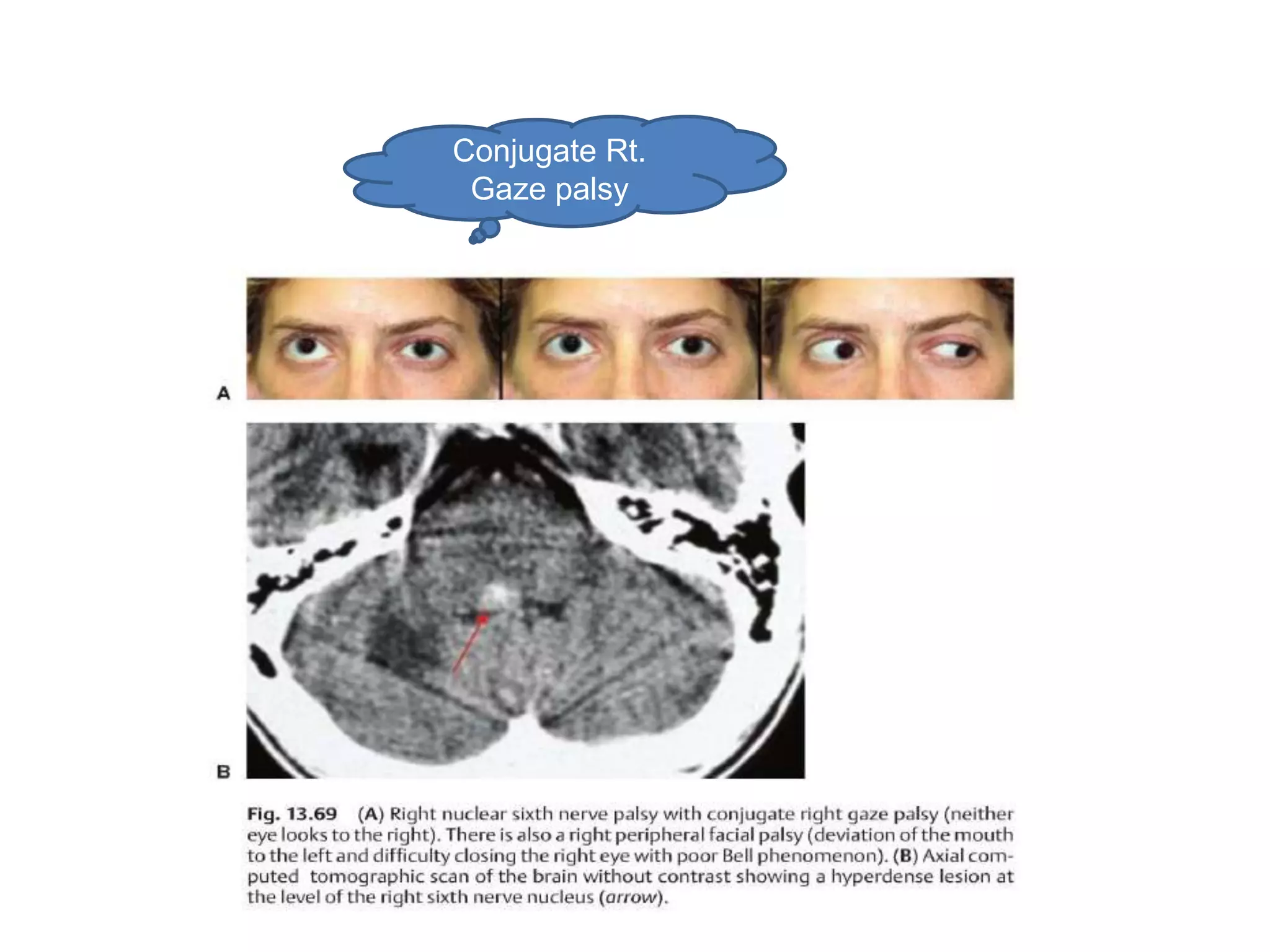 Conjugate Rt.
 Gaze palsy
 