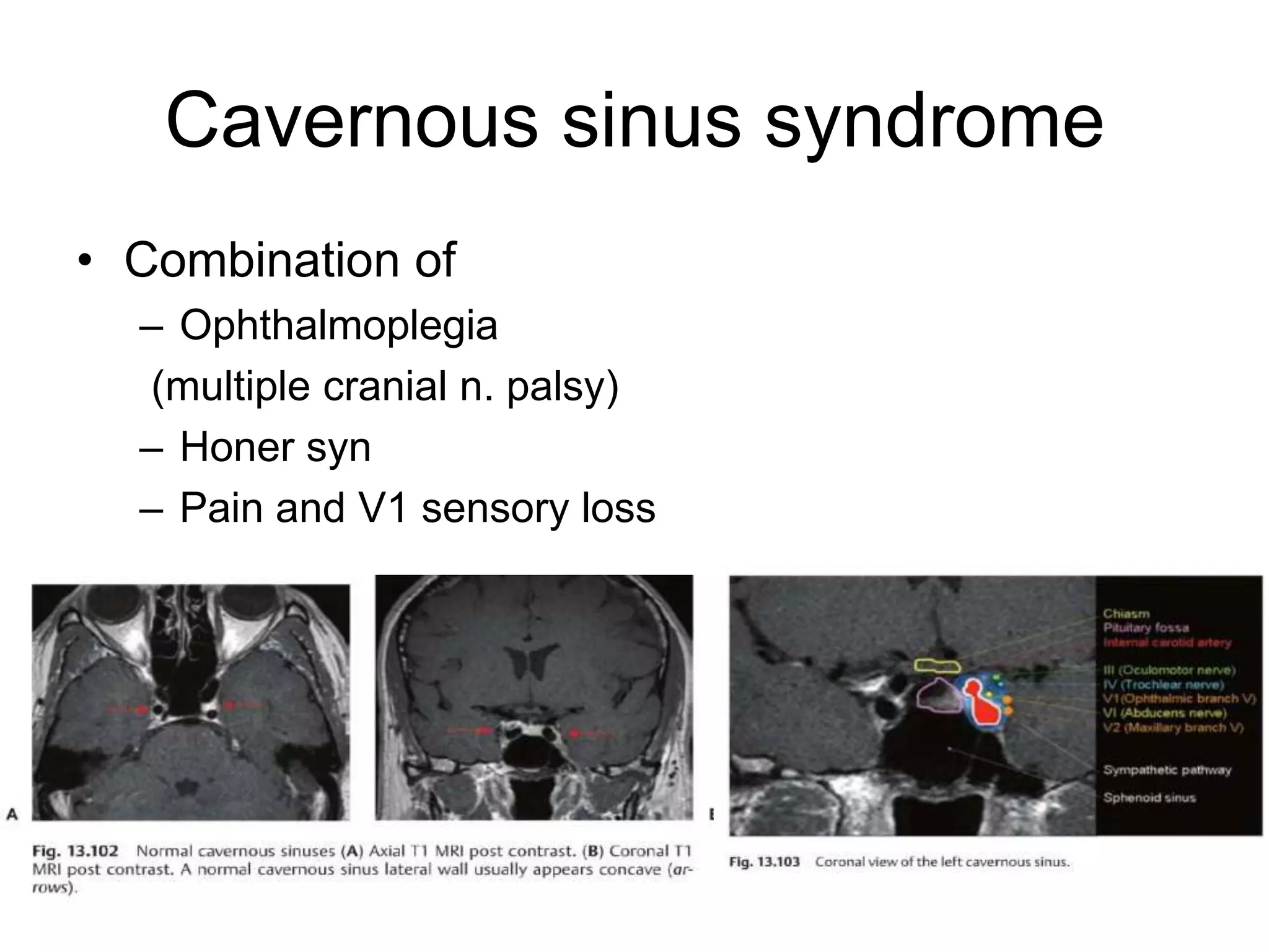 Cavernous sinus syndrome
• Combination of
  – Ophthalmoplegia
  (multiple cranial n. palsy)
  – Honer syn
  – Pain and V1 sensory loss
 