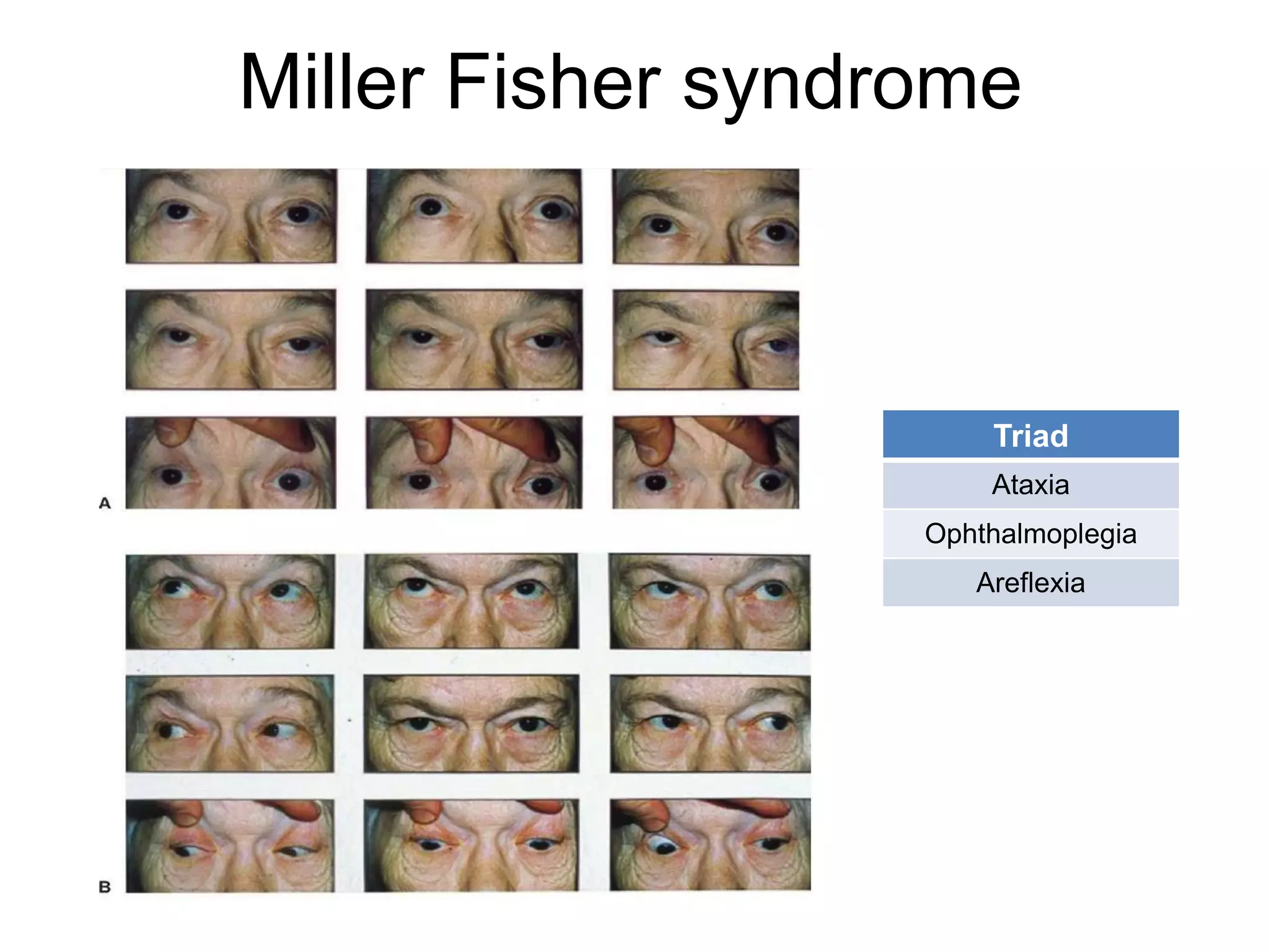 Miller Fisher syndrome



                       Triad
                       Ataxia
                   Ophthalmoplegia
                      Areflexia
 