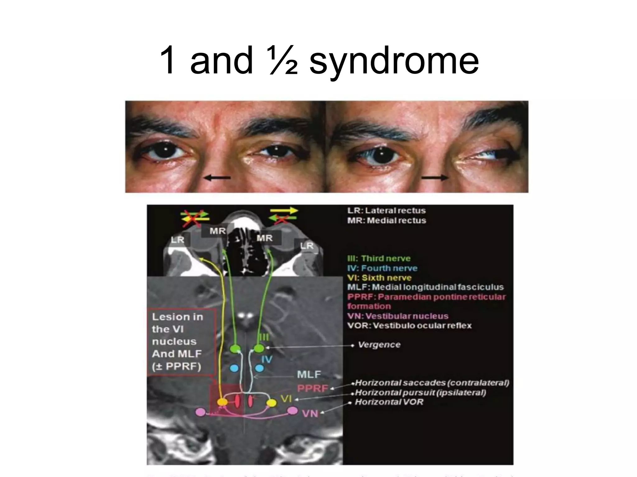 1 and ½ syndrome
 