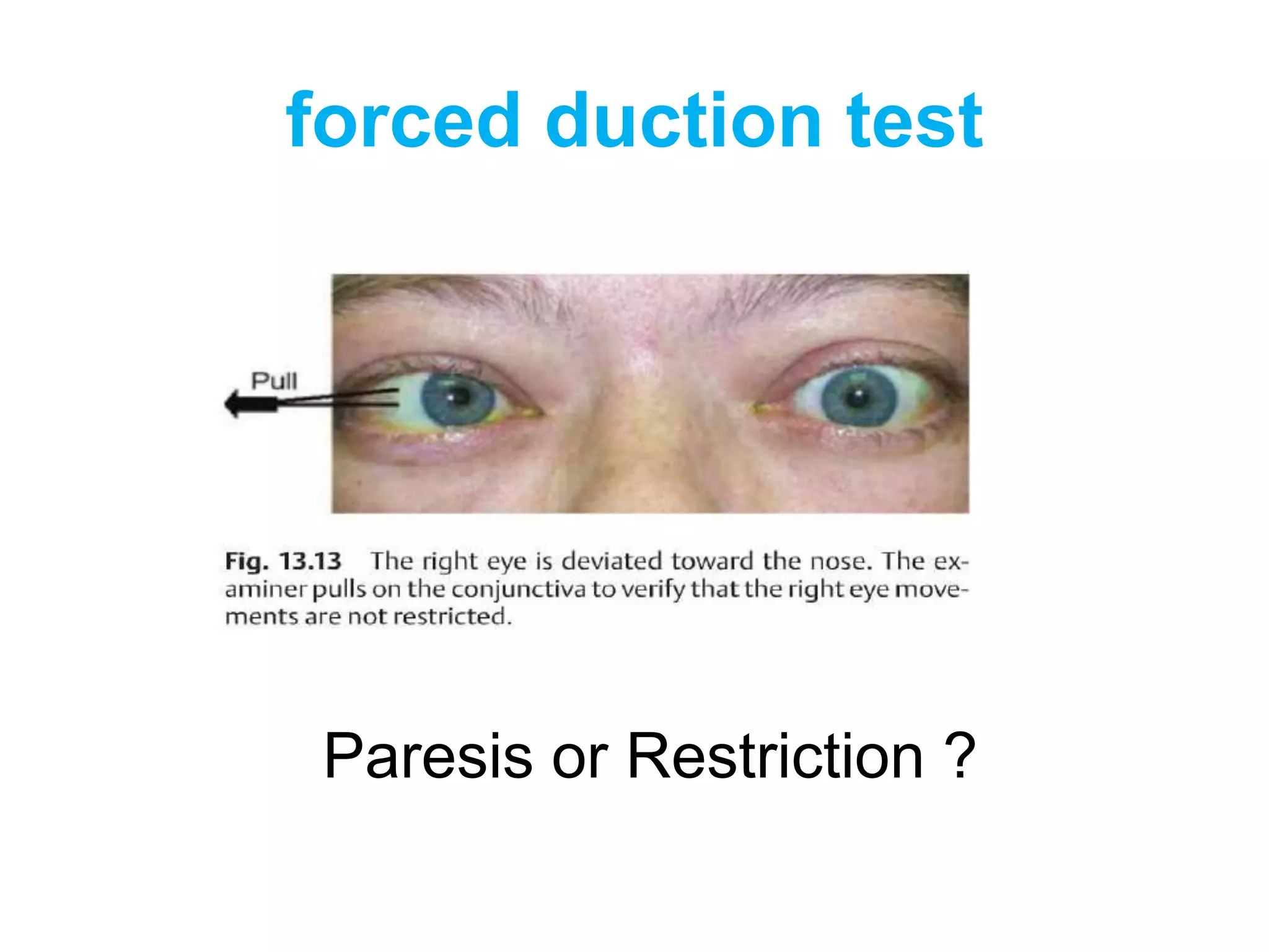 forced duction test




 Paresis or Restriction ?
 