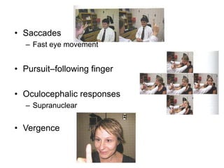 • Saccades
  – Fast eye movement


• Pursuit–following finger

• Oculocephalic responses
  – Supranuclear


• Vergence
 