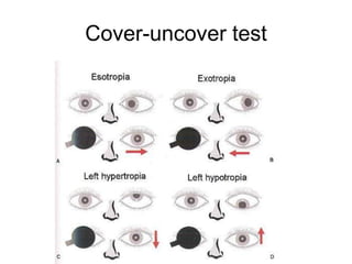 Cover-uncover test
 