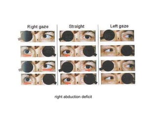 right abduction deficit
 