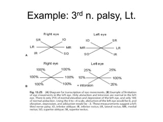 Example: 3rd n. palsy, Lt.
 