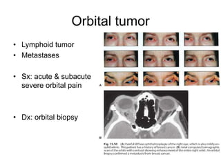 Orbital tumor
• Lymphoid tumor
• Metastases

• Sx: acute & subacute
  severe orbital pain



• Dx: orbital biopsy
 