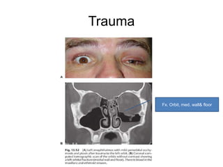 Trauma




         Fx. Orbit, med. wall& floor
 