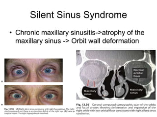 Silent Sinus Syndrome
• Chronic maxillary sinusitis->atrophy of the
  maxillary sinus -> Orbit wall deformation
 
